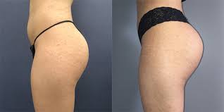 Glutei Fit risultati