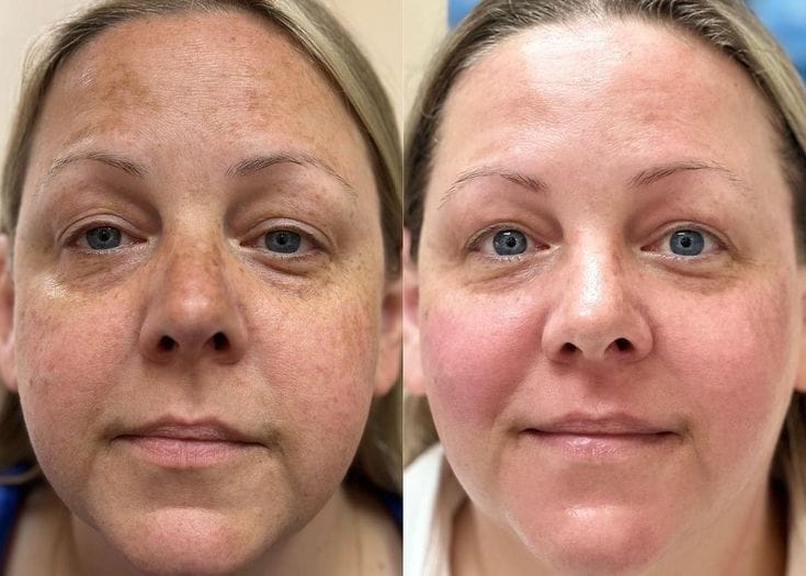Before & After