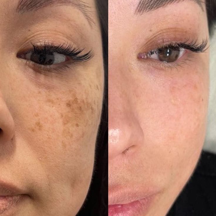 Laser Skin Resurfacing_ Types, Effects, Risks, Cost