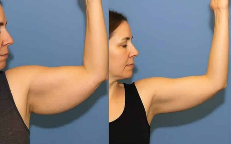 Spirulipo prima e dopo braccia