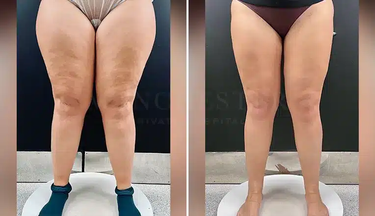 lipedema-liposuction-before-and-after-patient-1-v1